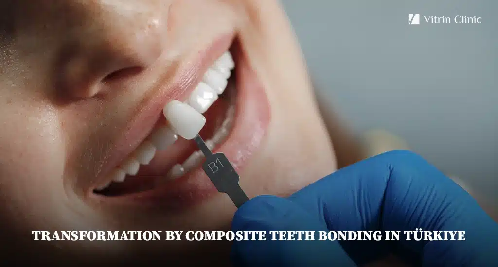 Composite Veneer in Turkey