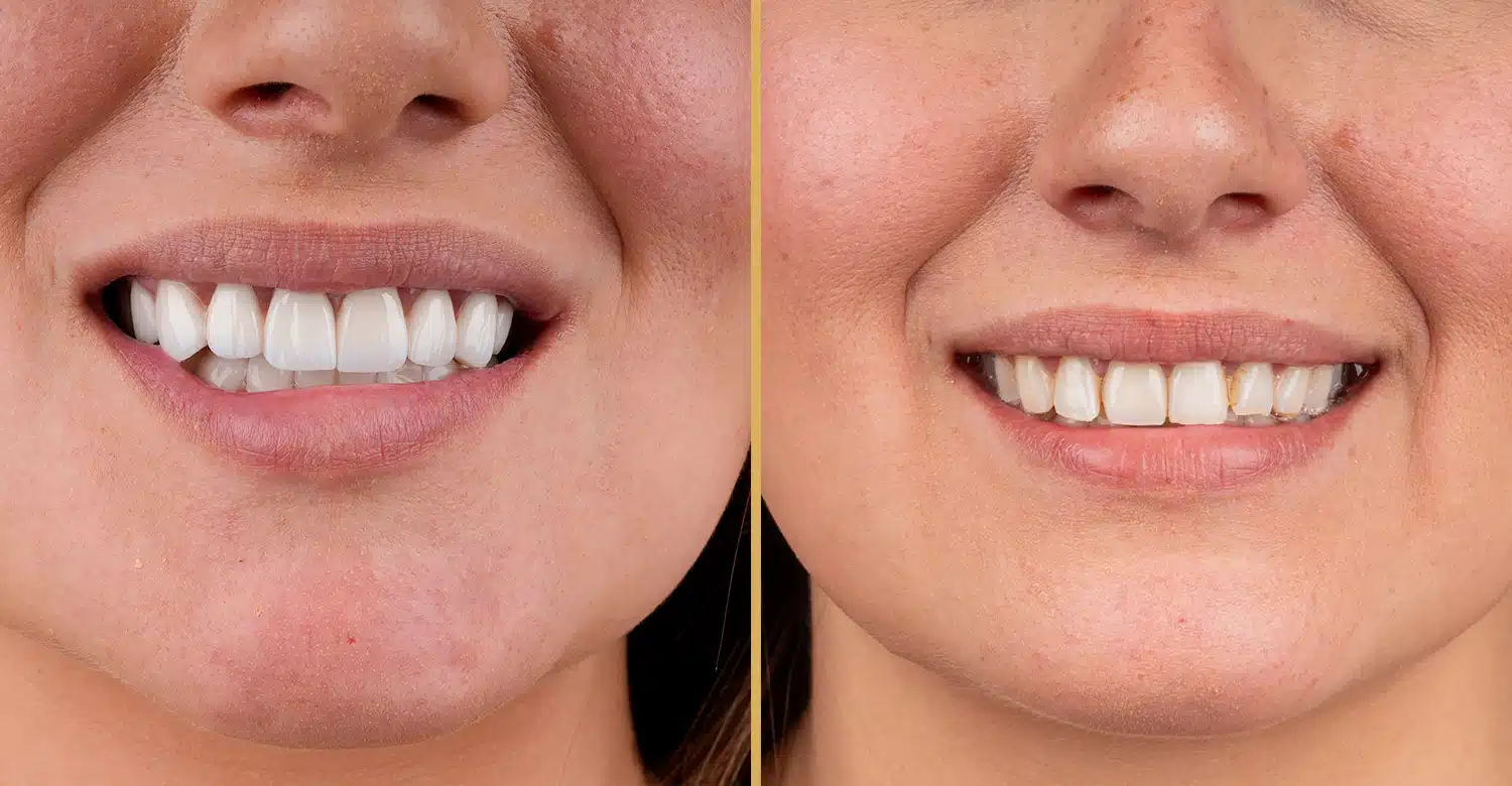 Veneers Cost in Turkey 2025
