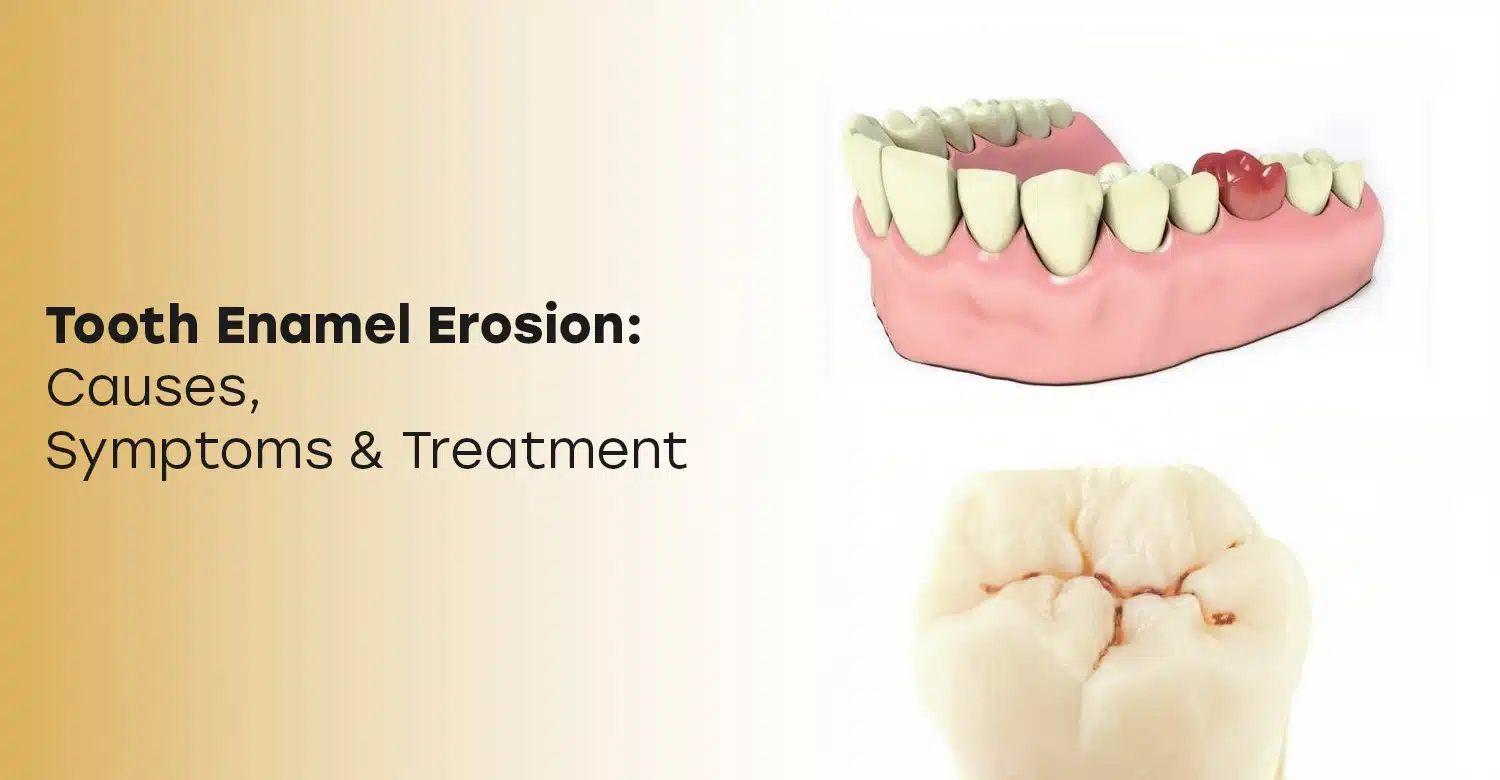 Tooth Enamel Erosion: Causes & Treatments in Turkey 2025?