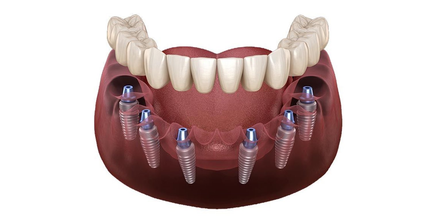 All-on-6 Dental Implants Turkey Price 2025