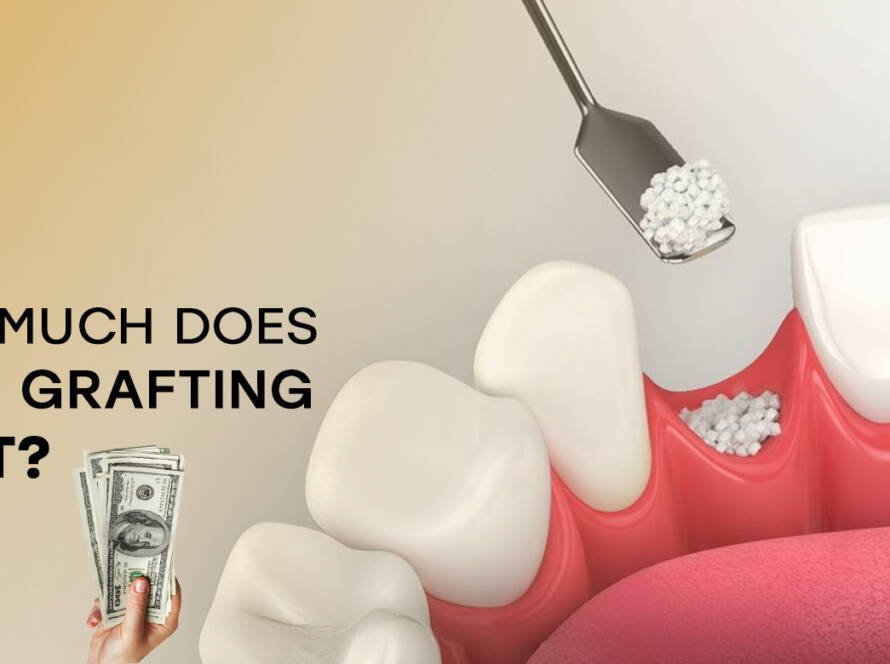 Cost of bone grafting