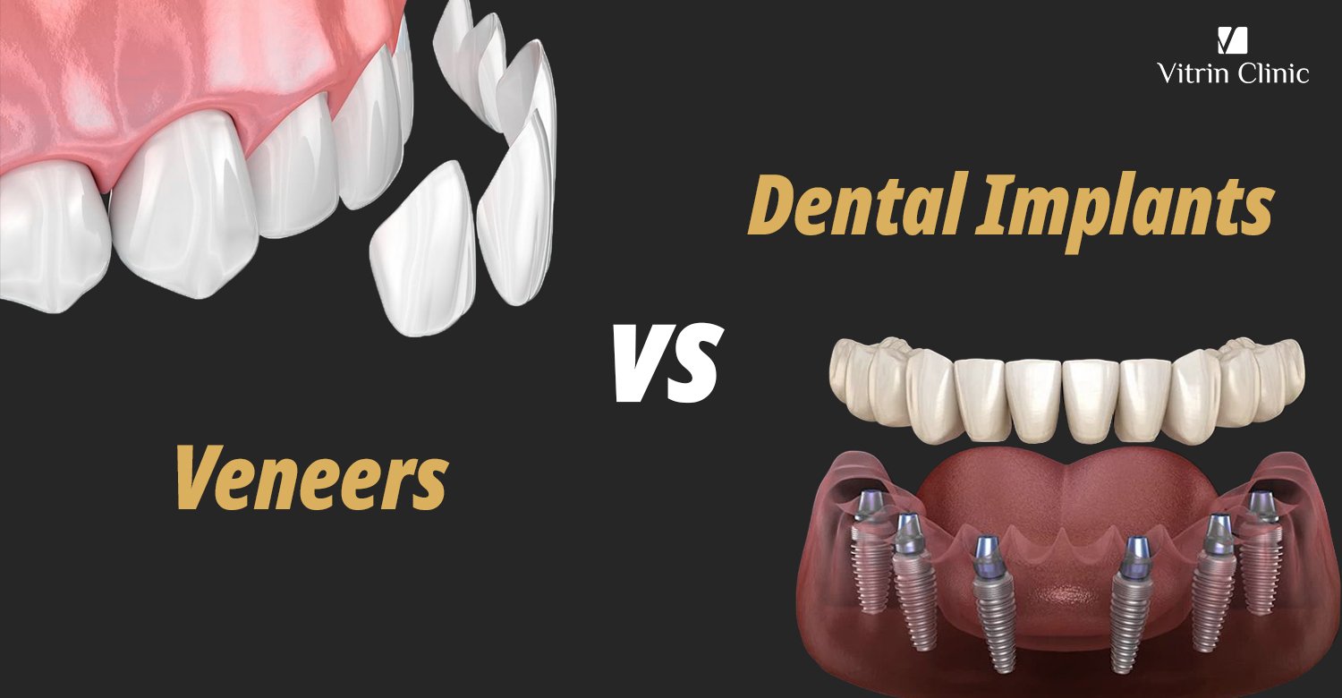 Dental Implants vs Veneers