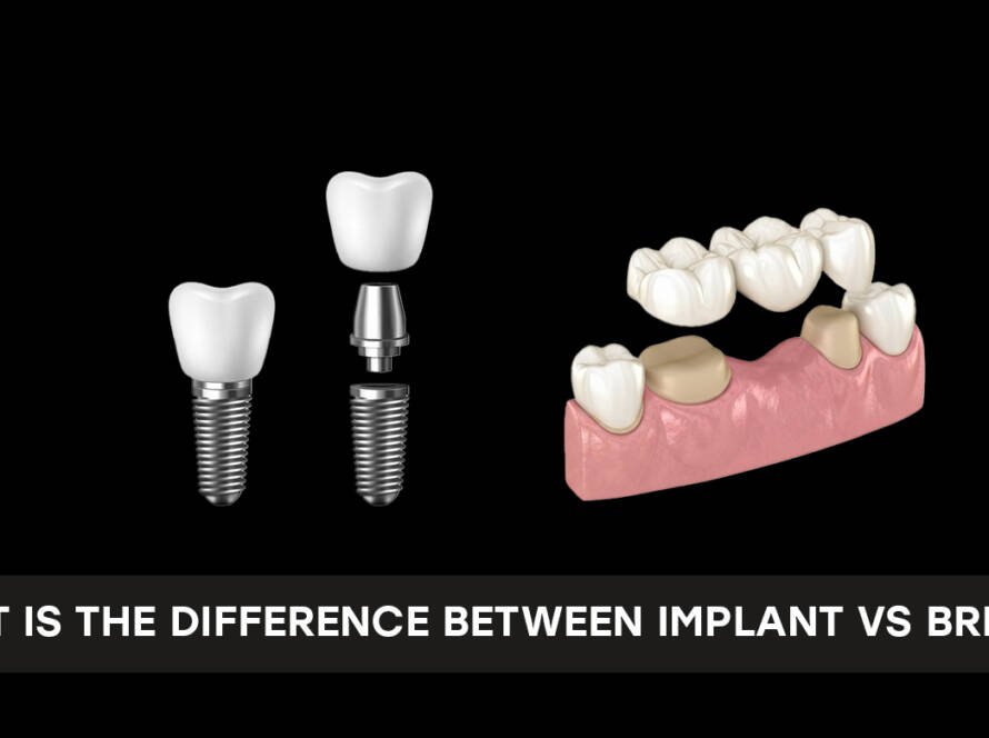 Implant vs bridge