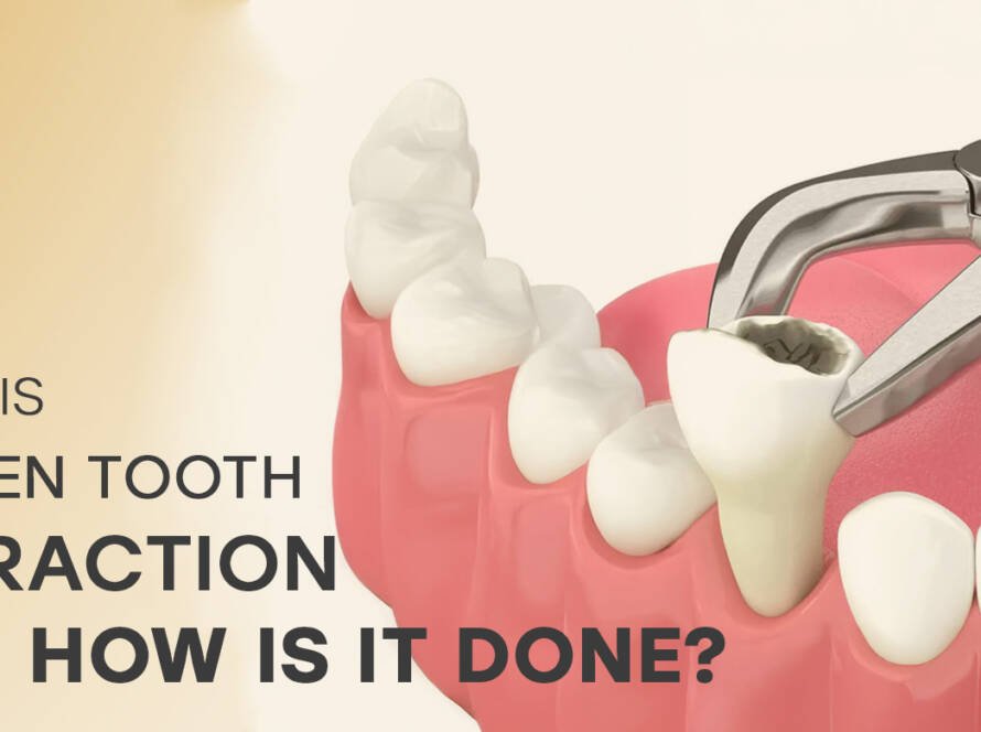 Rotten tooth extraction