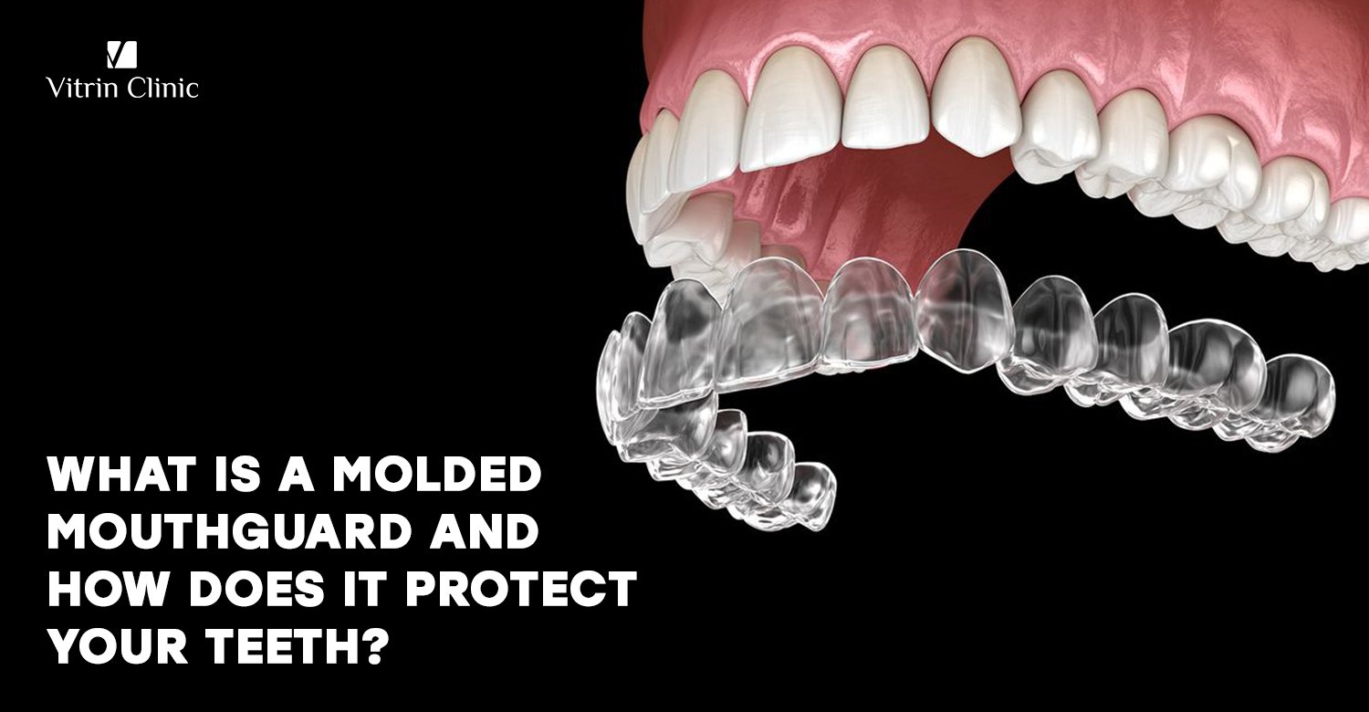 molded mouthguard