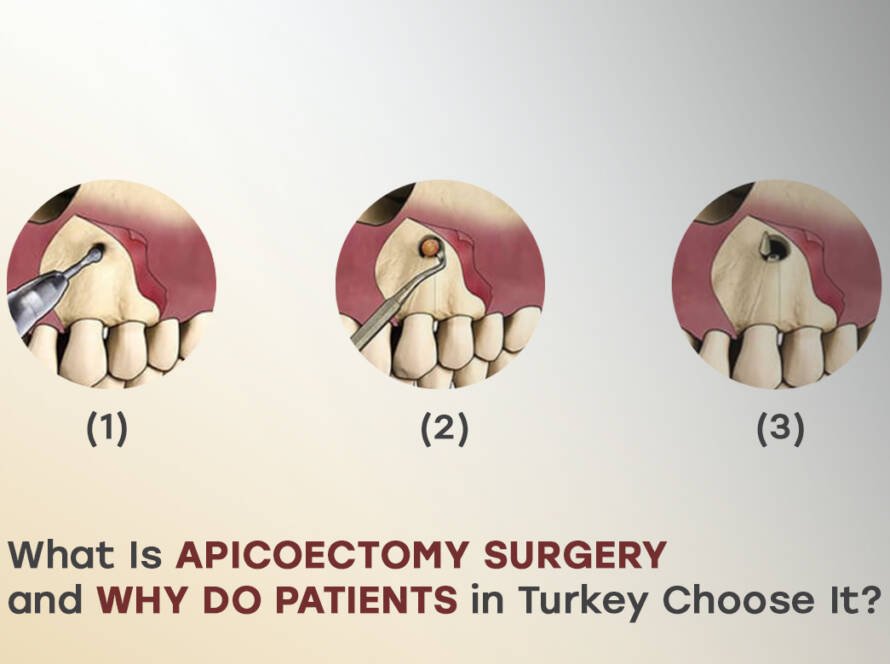 Apicoectomy surgery