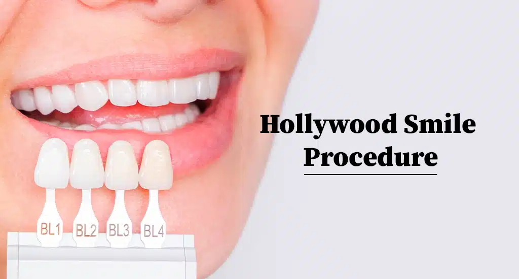 Hollywood smile proccedre in Turkey
