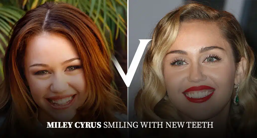 Miley Cyrus Teeth Before and After