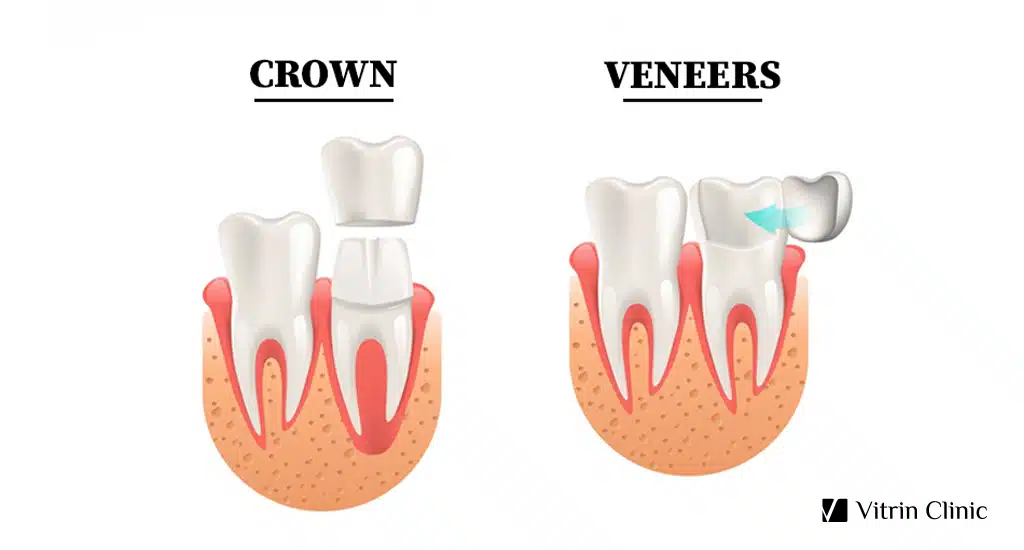 Veneers vs Crowns