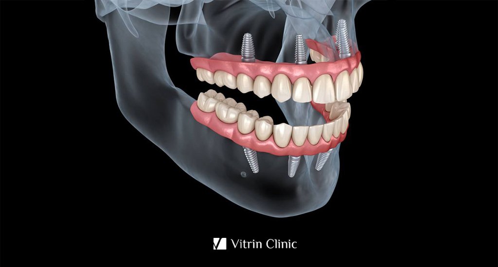 Full Mouth Dental Implants