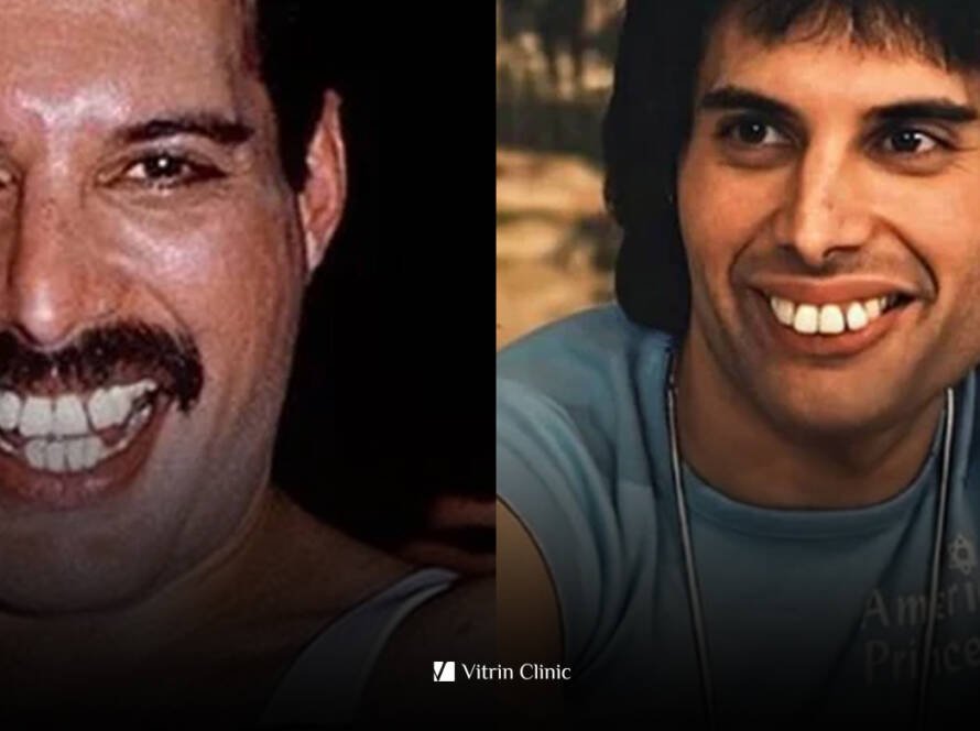 Freddie Mercury Teeth