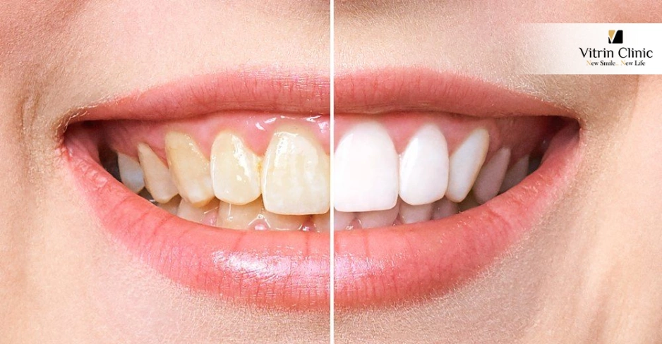 How Dentists Choose the "Right Shade" Instead of the Whitest Shade