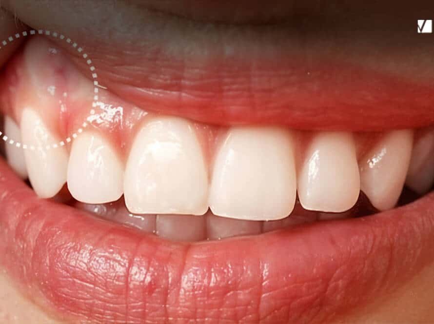White Gums