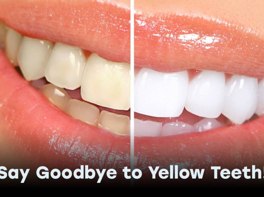 Yellow Teeth in Turkey 2025