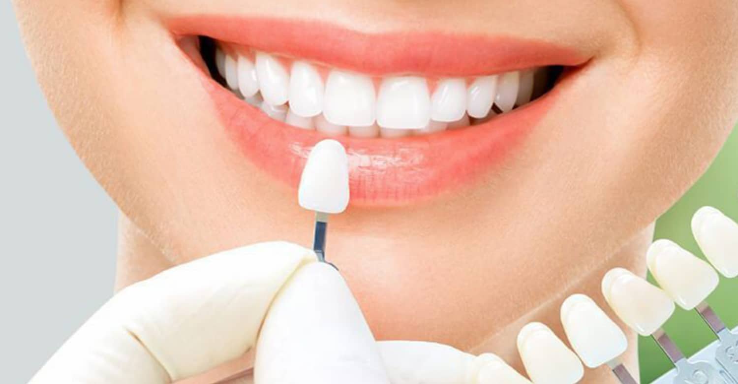 Cost of Veneers in Turkey 2025 A Comprehensive Guide by Vitrin Clinic