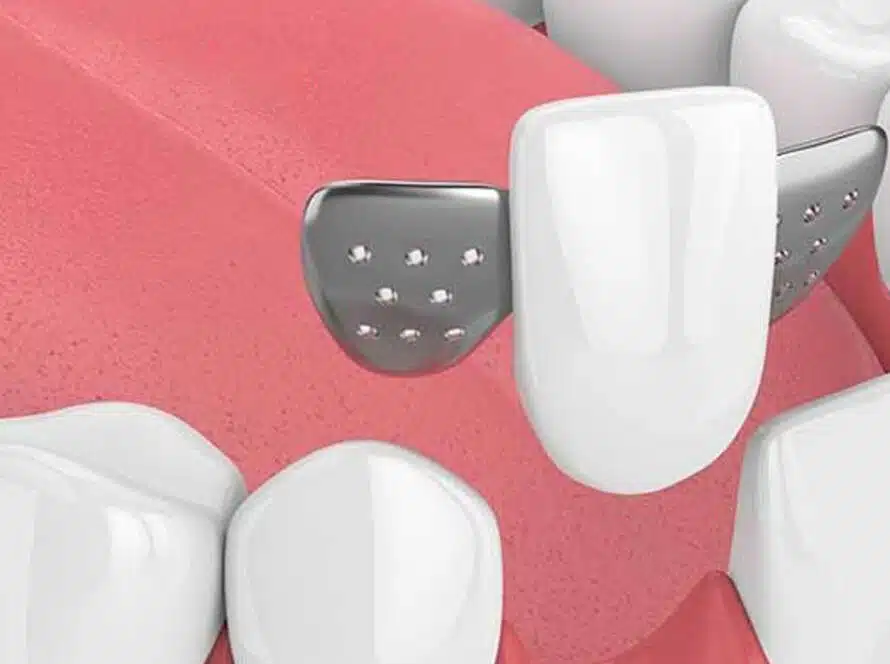 The Maryland Bridges What to Know About This Tooth Replacement Option
