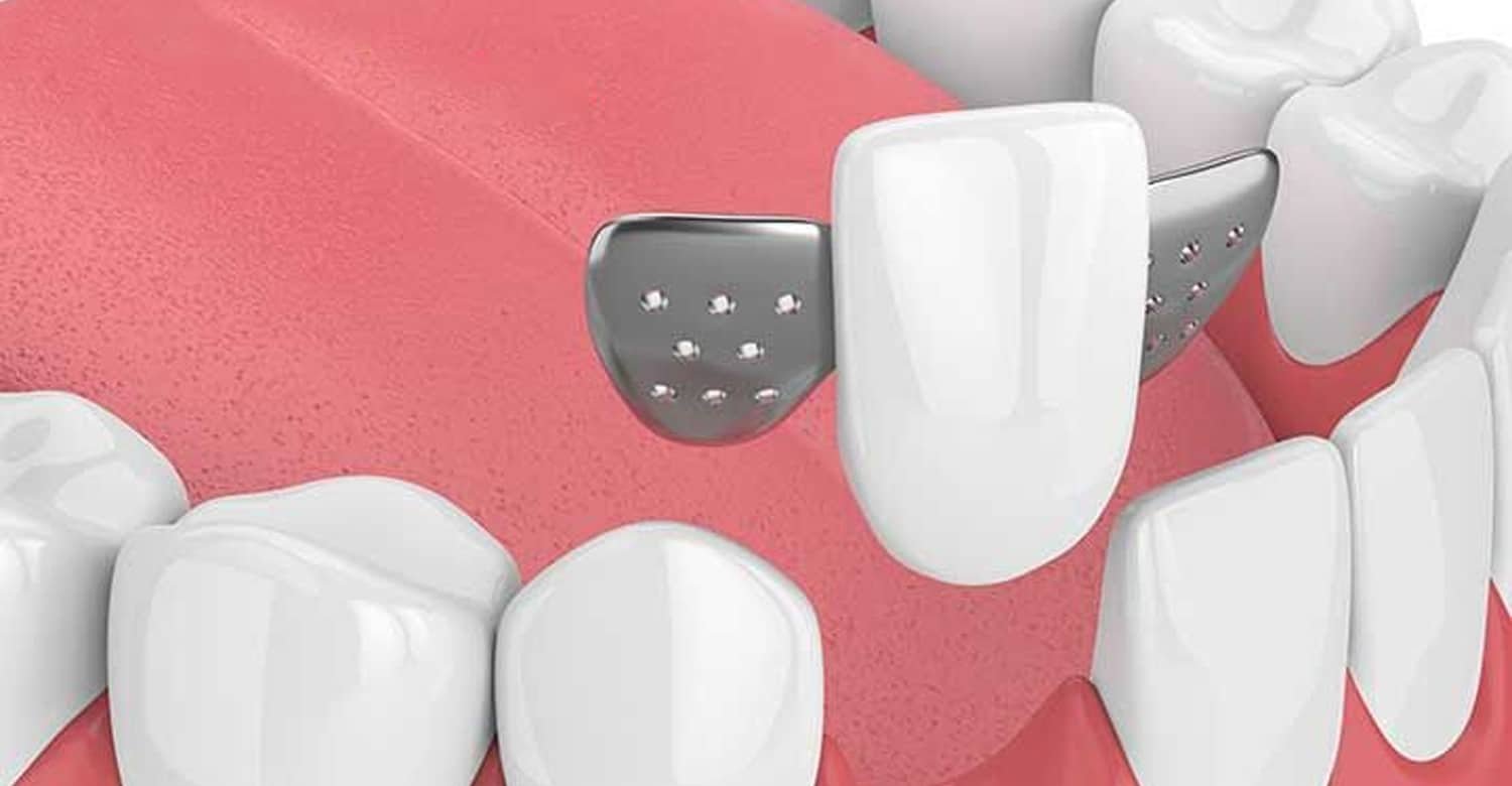 The Maryland Bridges What to Know About This Tooth Replacement Option