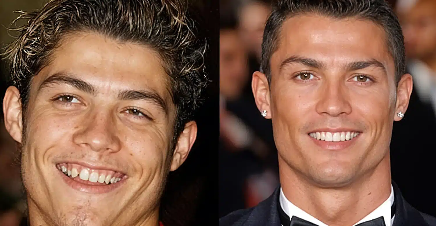 Want a Hollywood Smile Like Cristiano Ronaldo Say Siuuuuu! to Vitrin Clinic’s Makeover Magic at Istanbul