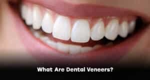 What Are Dental Veneers