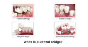 What Is a Dental Bridge