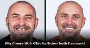 Why Choose Vitrin Clinic for Broken Tooth Treatment