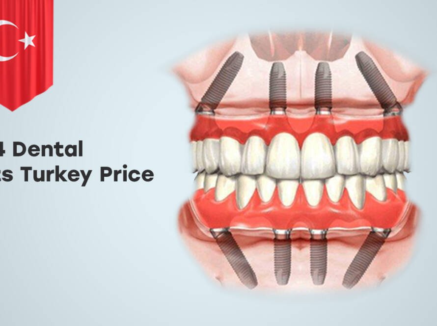 All-on-4 Dental Implants Turkey Price
