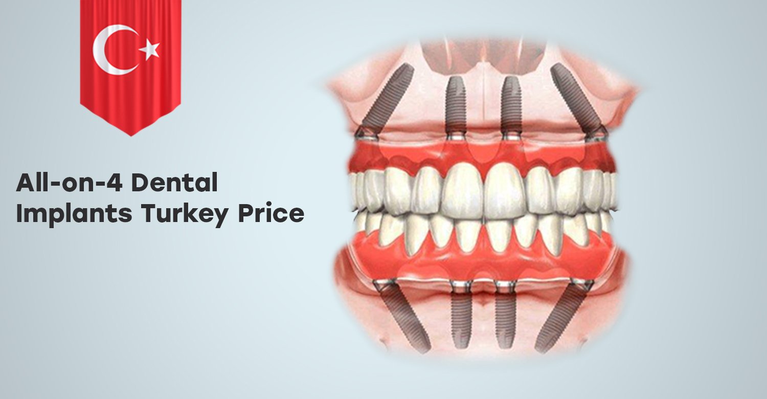 All-on-4 Dental Implants Turkey Price