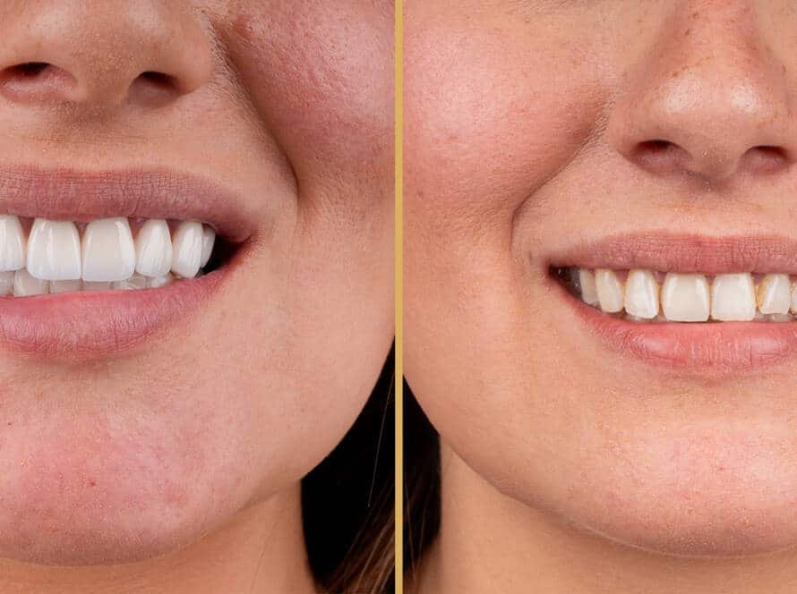 Veneers Cost in Turkey 2025