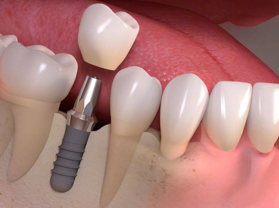 Dental Implant Cost in Turkey 2025