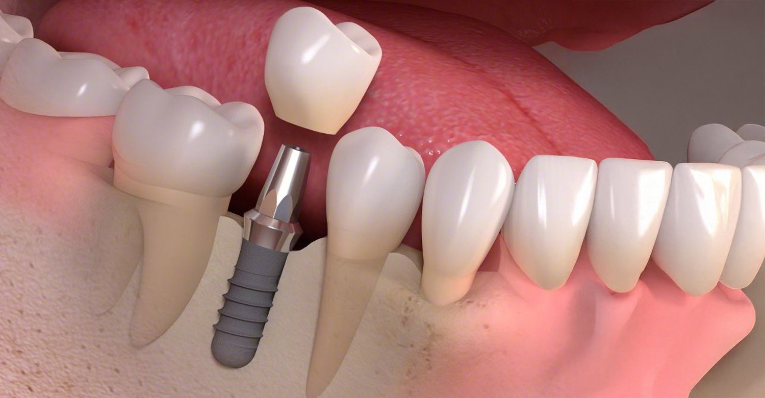 Dental Implant Cost in Turkey 2025