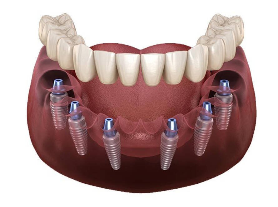 All-on-6 Dental Implants Turkey Price 2025