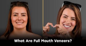 Is It Worth Getting Full Mouth Veneers in Turkey