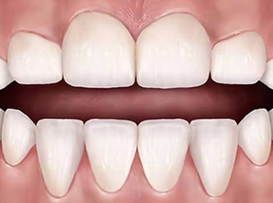 Pacifier Teeth in Turkey