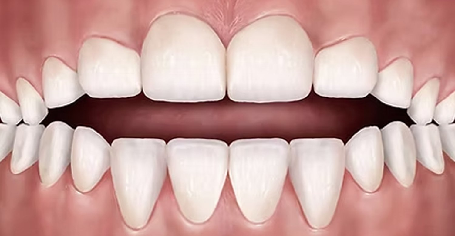 Pacifier Teeth in Turkey