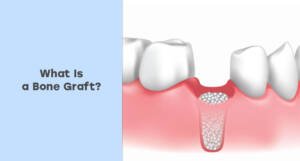 What Is a Bone Graft