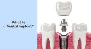 What Is a Dental Implant