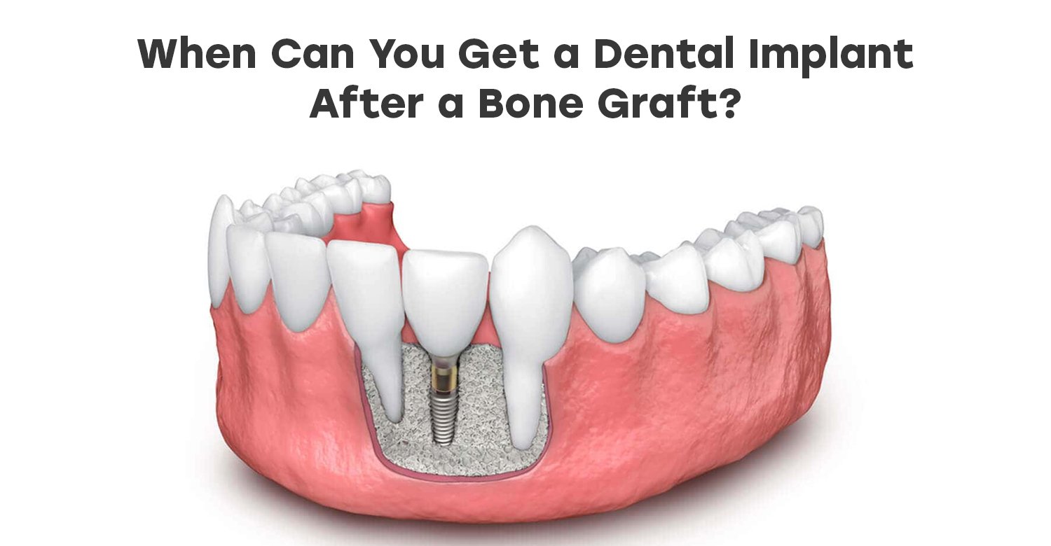 When Can You Get a Dental Implant After a Bone Graft