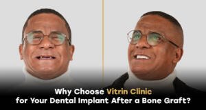 Why Choose Vitrin Clinic for Your Dental Implant After a Bone Graft