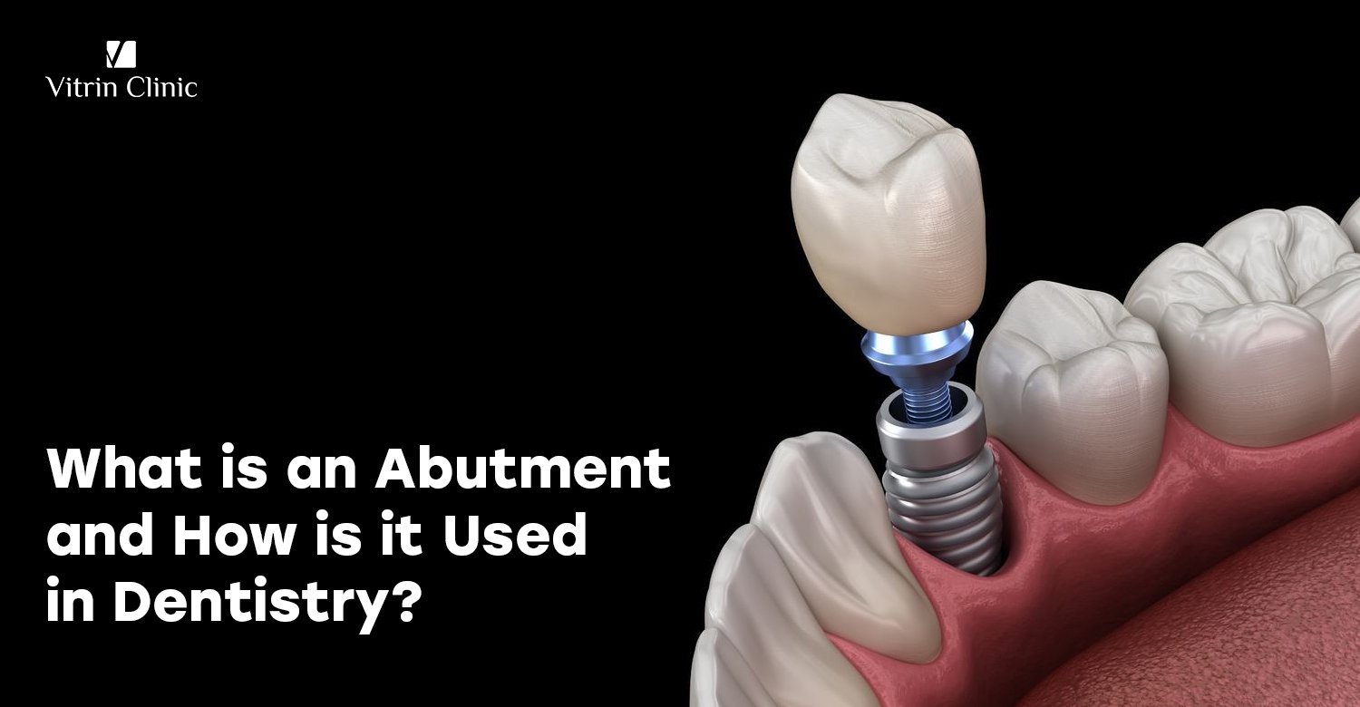 Abutments