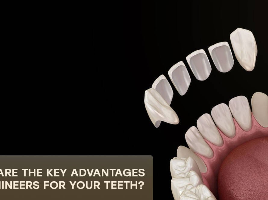 Advantages of lumineers