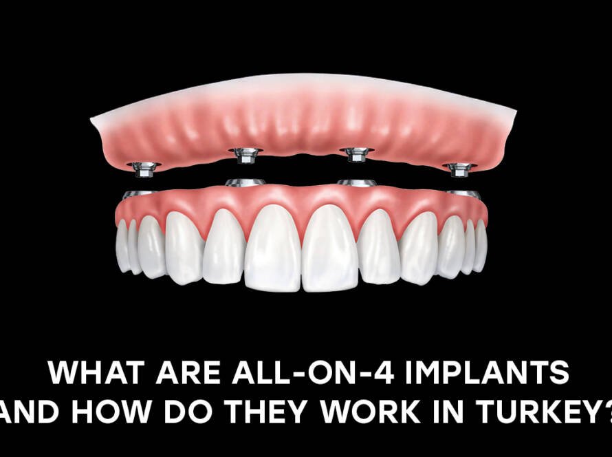 All-on-4 implants