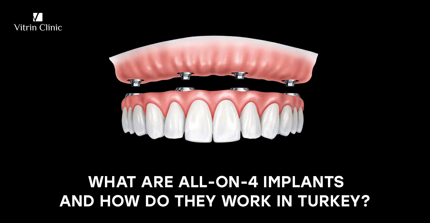 All-on-4 implants