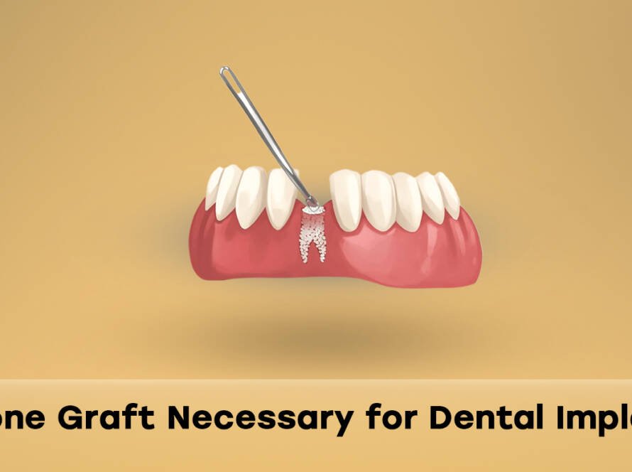 Bone graft for implants