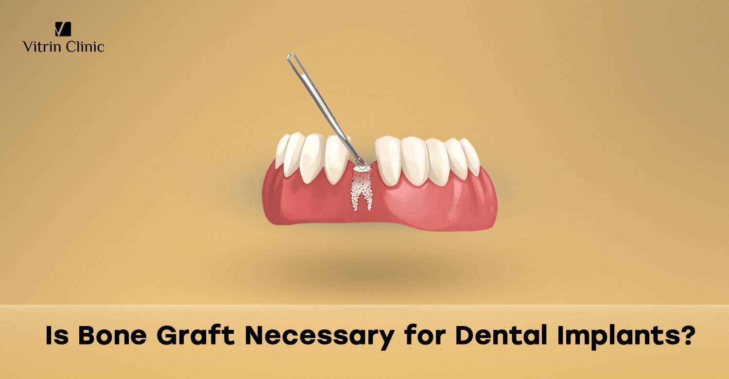 Bone graft for implants