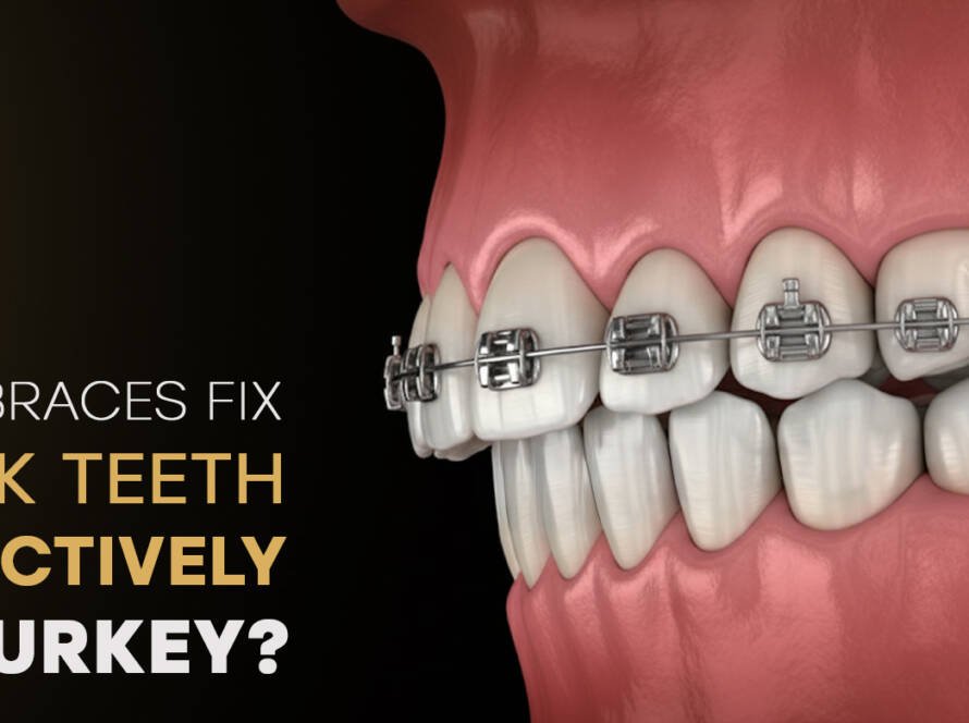 Braces for buck teeth