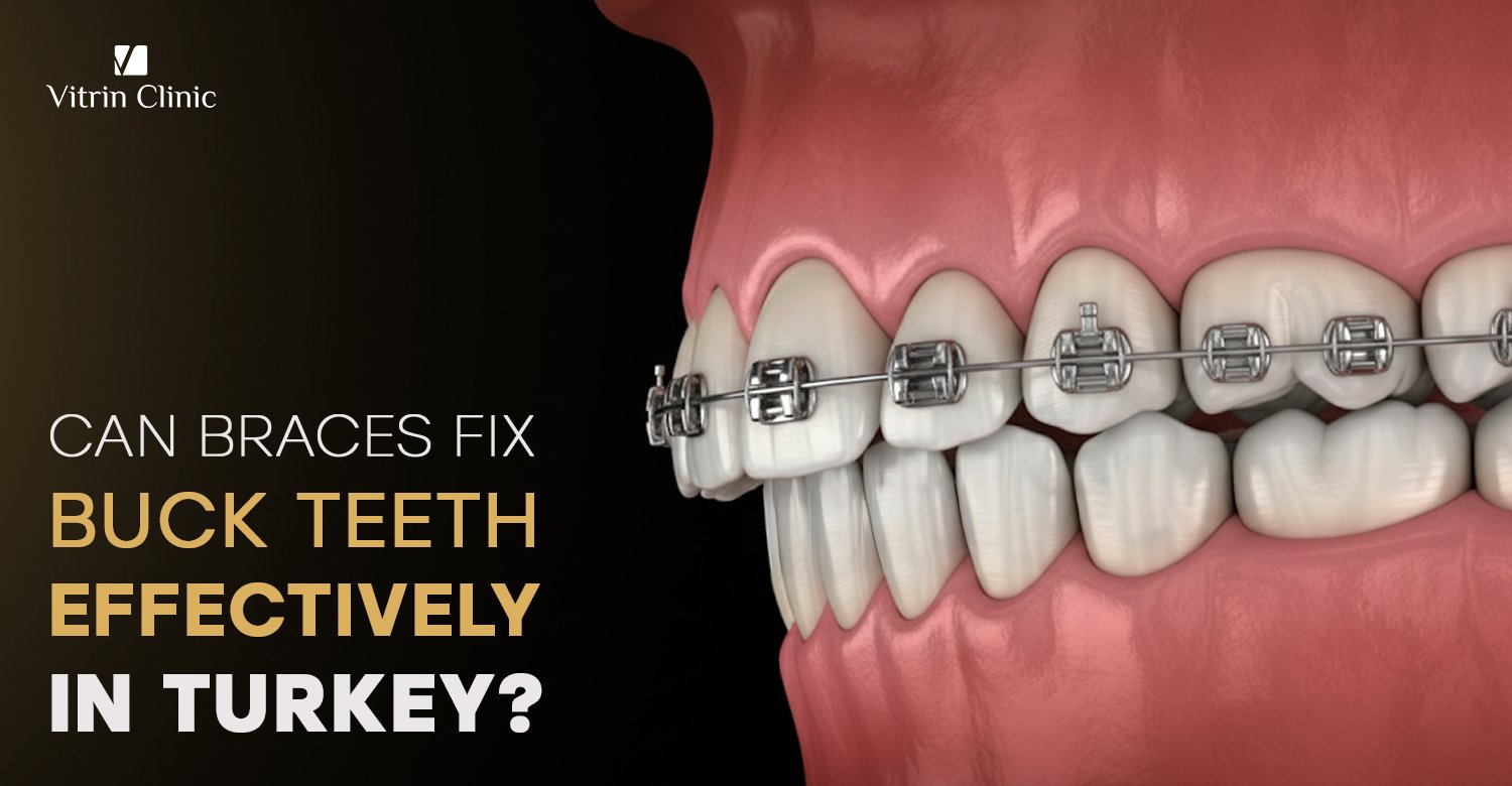 Braces for buck teeth