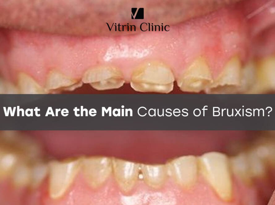 Causes of bruxism
