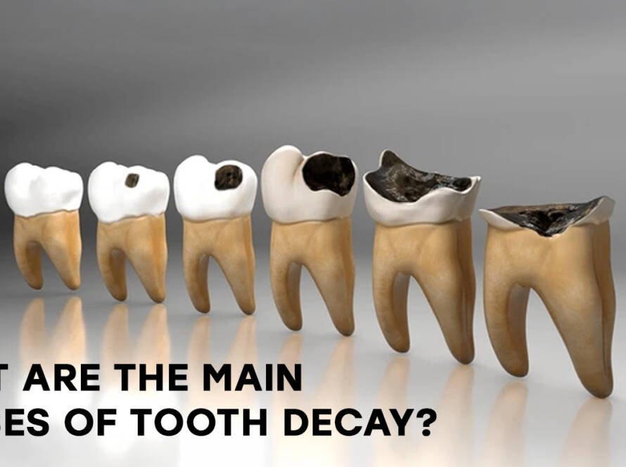 Causes of tooth decay
