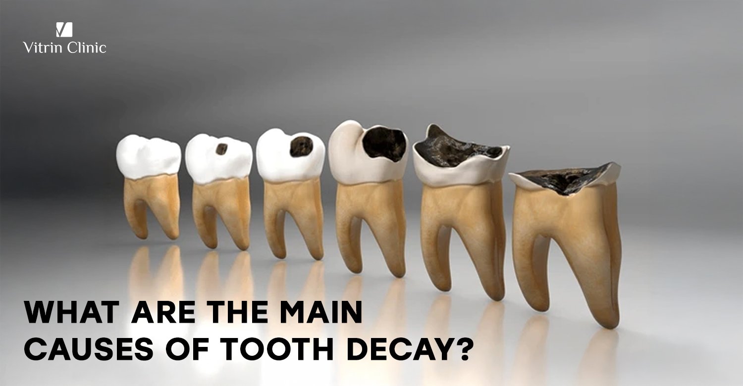 Causes of tooth decay