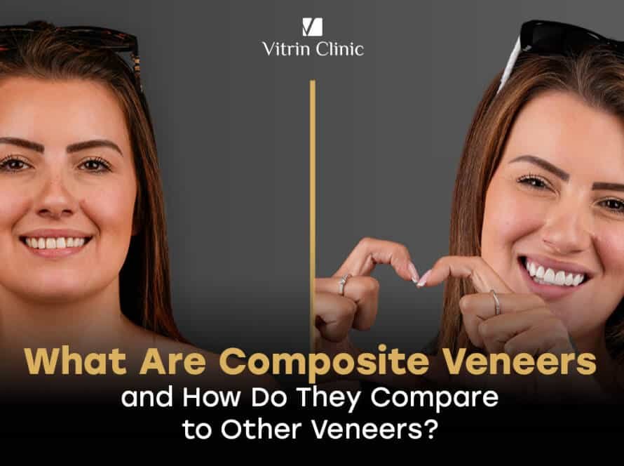 Composite veneers